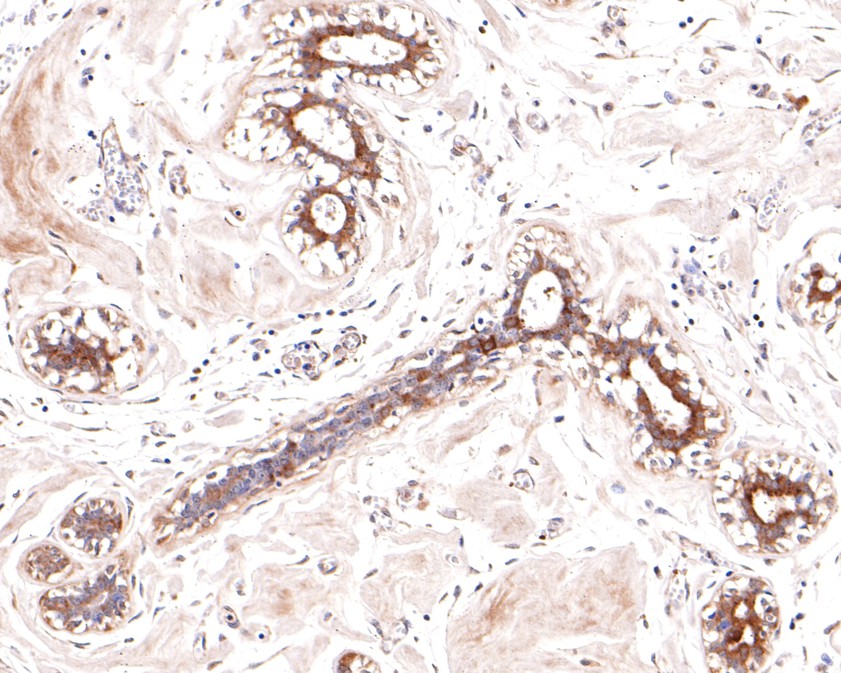 Immunohistochemical analysis of paraffin-embedded human breast tissue using anti-Galactosidase alpha antibody. The section was pre-treated using heat mediated antigen retrieval with Tris-EDTA buffer (pH 9.0) for 20 minutes.The tissues were blocked in 1% BSA for 30 minutes at room temperature, washed with ddH2O and PBS, and then probed with the primary antibody (HA500245, 1/600) for 30 minutes at room temperature. The detection was performed using an HRP conjugated compact polymer system. DAB was used as the chromogen. Tissues were counterstained with hematoxylin and mounted with DPX.