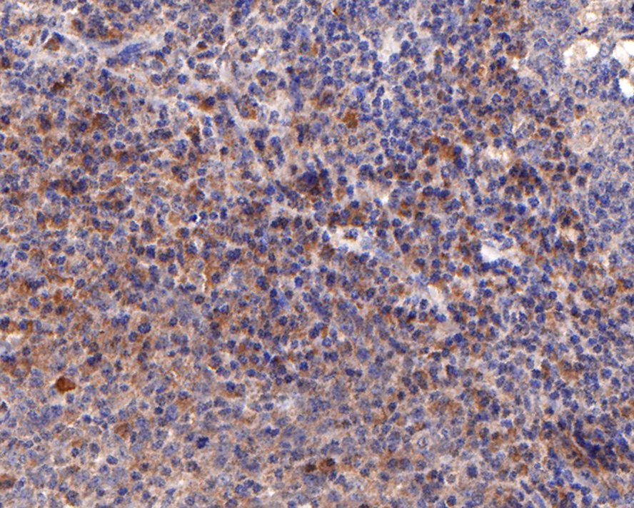 Immunohistochemical analysis of paraffin-embedded human tonsil tissue with Rabbit anti-IL-2RG antibody (HA500269) at 1/600 dilution.<br />
<br />
The section was pre-treated using heat mediated antigen retrieval with Tris-EDTA buffer (pH 9.0) for 20 minutes. The tissues were blocked in 5% BSA for 30 minutes at room temperature, washed with ddH2O and PBS, and then probed with the primary antibody (HA500269) at 1/600 dilution for 30 minutes at room temperature. The detection was performed using an HRP conjugated compact polymer system. DAB was used as the chromogen. Tissues were counterstained with hematoxylin and mounted with DPX.
