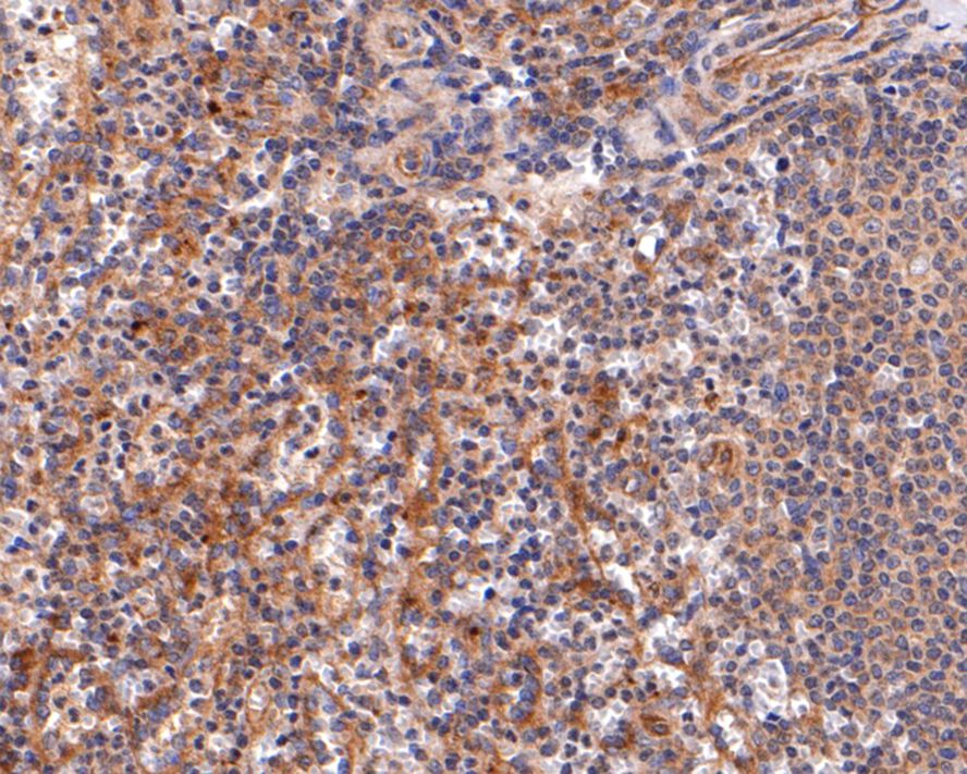 Immunohistochemical analysis of paraffin-embedded human spleen tissue with Rabbit anti-IL-2RG antibody (HA500269) at 1/600 dilution.<br />
<br />
The section was pre-treated using heat mediated antigen retrieval with Tris-EDTA buffer (pH 9.0) for 20 minutes. The tissues were blocked in 5% BSA for 30 minutes at room temperature, washed with ddH2O and PBS, and then probed with the primary antibody (HA500269) at 1/600 dilution for 30 minutes at room temperature. The detection was performed using an HRP conjugated compact polymer system. DAB was used as the chromogen. Tissues were counterstained with hematoxylin and mounted with DPX.