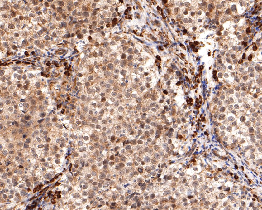 Immunohistochemical analysis of paraffin-embedded human seminoma tissue using anti-REST antibody. The section was pre-treated using heat mediated antigen retrieval with sodium citrate buffer (pH 6.0) for 20 minutes. The tissues were blocked in 1% BSA for 30 minutes at room temperature, washed with ddH2O and PBS, and then probed with the primary antibody (HA720081, 1/400)  for 30 minutes at room temperature. The detection was performed using an HRP conjugated compact polymer system. DAB was used as the chromogen. Tissues were counterstained with hematoxylin and mounted with DPX.