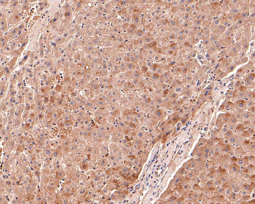 Immunohistochemical analysis of paraffin-embedded human liver tissue using anti-Spry2 antibody. The section was pre-treated using heat mediated antigen retrieval with Tris-EDTA buffer (pH 9.0) for 20 minutes.The tissues were blocked in 1% BSA for 30 minutes at room temperature, washed with ddH2O and PBS, and then probed with the primary antibody (HA500170, 1/200) for 30 minutes at room temperature. The detection was performed using an HRP conjugated compact polymer system. DAB was used as the chromogen. Tissues were counterstained with hematoxylin and mounted with DPX.