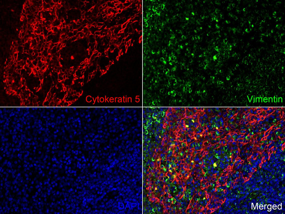 Immunofluorescence analysis of paraffin-embedded human tonsil tissue labeling Cytokeratin 5 (HA720121F) and Vimentin (EM0401).<br />
<br />
The section was pre-treated using heat mediated antigen retrieval with Tris-EDTA buffer (pH 9.0) for 20 minutes. The tissues were blocked in 10% negative goat serum for 1 hour at room temperature, washed with PBS. And then probed with the primary antibodies Cytokeratin 5 (HA720121F, red) at 1/50 dilution and Vimentin (EM0401, green) at 1/200 dilution at +4℃ overnight, washed with PBS.<br />
<br />
Goat Anti-Mouse IgG H&L (iFluor™ 488, HA1125) were used as the secondary antibody at 1/1,000 dilution. Nuclei were counterstained with DAPI (blue).
