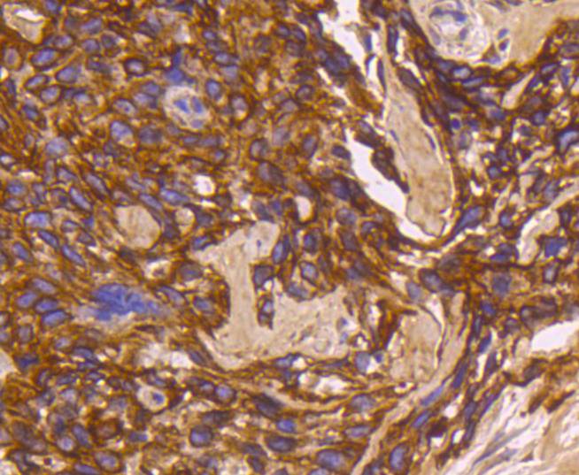 Immunohistochemical analysis of paraffin-embedded human breast carcinoma tissue using anti-Cytokeratin 16 antibody. The section was pre-treated using heat mediated antigen retrieval with Tris-EDTA buffer (pH 8.0-8.4) for 20 minutes.The tissues were blocked in 5% BSA for 30 minutes at room temperature, washed with ddH2O and PBS, and then probed with the primary antibody (ET1610-17, 1/50) for 30 minutes at room temperature. The detection was performed using an HRP conjugated compact polymer system. DAB was used as the chromogen. Tissues were counterstained with hematoxylin and mounted with DPX.