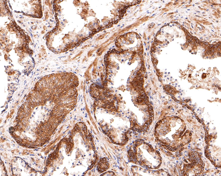 Immunohistochemical analysis of paraffin-embedded human prostate tissue using anti-ABCF1 antibody. The section was pre-treated using heat mediated antigen retrieval with sodium citrate buffer (pH 6.0) for 20 minutes. The tissues were blocked in 1% BSA for 30 minutes at room temperature, washed with ddH2O and PBS, and then probed with the primary antibody (ET1611-63, 1/400)  for 30 minutes at room temperature. The detection was performed using an HRP conjugated compact polymer system. DAB was used as the chromogen. Tissues were counterstained with hematoxylin and mounted with DPX.