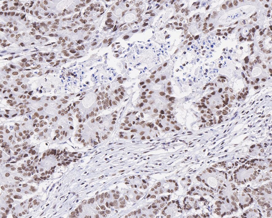Immunohistochemical analysis of paraffin-embedded human colon carcinoma tissue with Rabbit anti-ATF4 antibody (ET1612-37) at 1/1,000 dilution.<br />
<br />
The section was pre-treated using heat mediated antigen retrieval with sodium citrate buffer (pH 6.0) for 2 minutes. The tissues were blocked in 1% BSA for 20 minutes at room temperature, washed with ddH2O and PBS, and then probed with the primary antibody (ET1612-37) at 1/1,000 dilution for 1 hour at room temperature. The detection was performed using an HRP conjugated compact polymer system. DAB was used as the chromogen. Tissues were counterstained with hematoxylin and mounted with DPX.