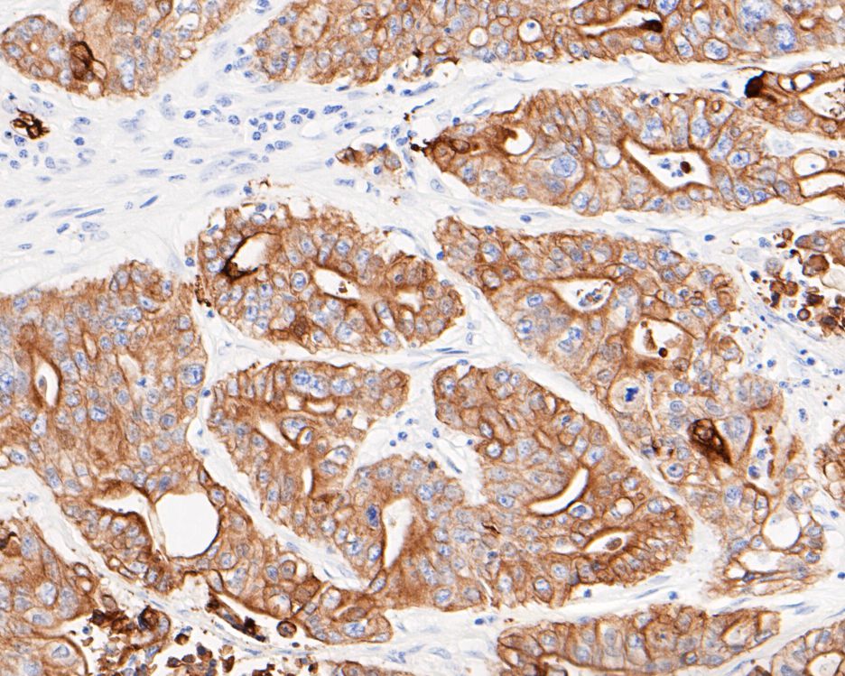 Immunohistochemical analysis of paraffin-embedded human colon carcinoma with Rabbit anti-Cytokeratin 18 antibody (ET1603-8) at 1/200 dilution. <br />
<br />
The section was pre-treated using heat mediated antigen retrieval with Tris-EDTA buffer (pH 9.0) for 20 minutes.The tissues were blocked in 5% BSA for 30 minutes at room temperature, washed with ddH2O and PBS, and then probed with the primary antibody (ET1603-8, 1/200) for 30 minutes at room temperature. The detection was performed using an HRP conjugated compact polymer system. DAB was used as the chromogen. Tissues were counterstained with hematoxylin and mounted with DPX.