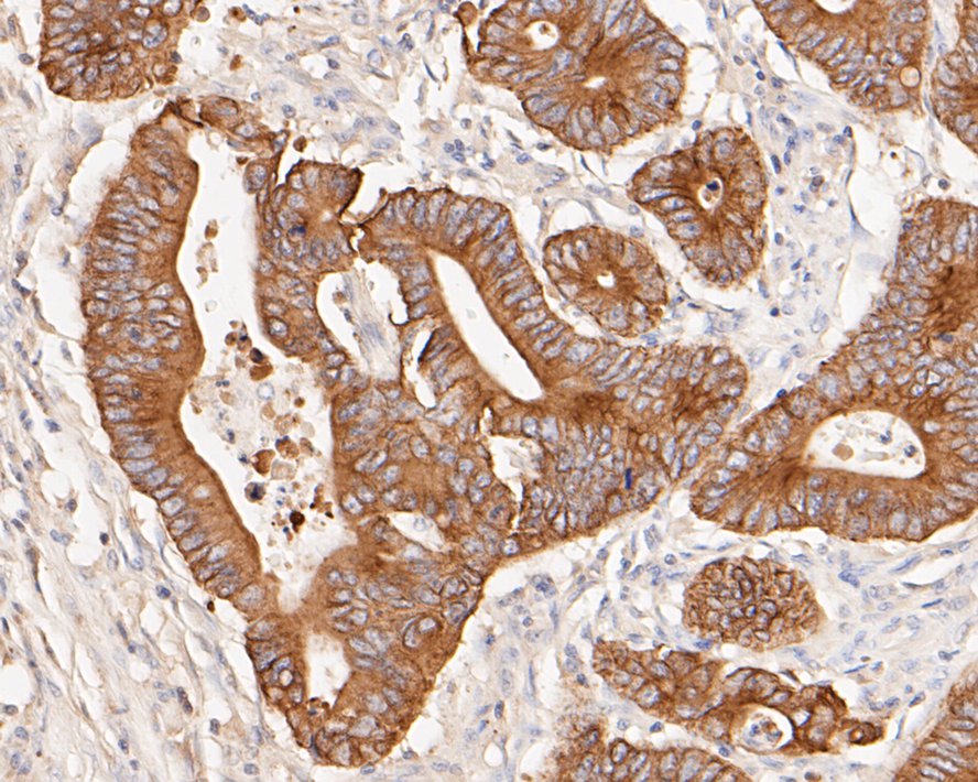 Immunohistochemical analysis of paraffin-embedded human liver tissue with Rabbit anti-Cytokeratin 18 antibody (ET1603-8) at 1/200 dilution. <br />
<br />
The section was pre-treated using heat mediated antigen retrieval with Tris-EDTA buffer (pH 9.0) for 20 minutes.The tissues were blocked in 5% BSA for 30 minutes at room temperature, washed with ddH2O and PBS, and then probed with the primary antibody (ET1603-8, 1/200) for 30 minutes at room temperature. The detection was performed using an HRP conjugated compact polymer system. DAB was used as the chromogen. Tissues were counterstained with hematoxylin and mounted with DPX.