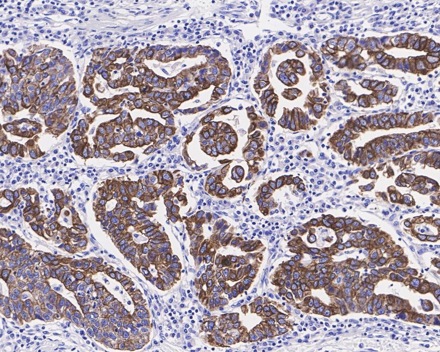 Immunohistochemical analysis of paraffin-embedded human stomach carcinoma tissue using anti-Cytokeratin 19 antibody. The section was pre-treated using heat mediated antigen retrieval with Tris-EDTA buffer (pH 9.0) for 20 minutes.The tissues were blocked in 5% BSA for 30 minutes at room temperature, washed with ddH2O and PBS, and then probed with the primary antibody (ET1601-6, 1/100) for 30 minutes at room temperature. The detection was performed using an HRP conjugated compact polymer system. DAB was used as the chromogen. Tissues were counterstained with hematoxylin and mounted with DPX.
