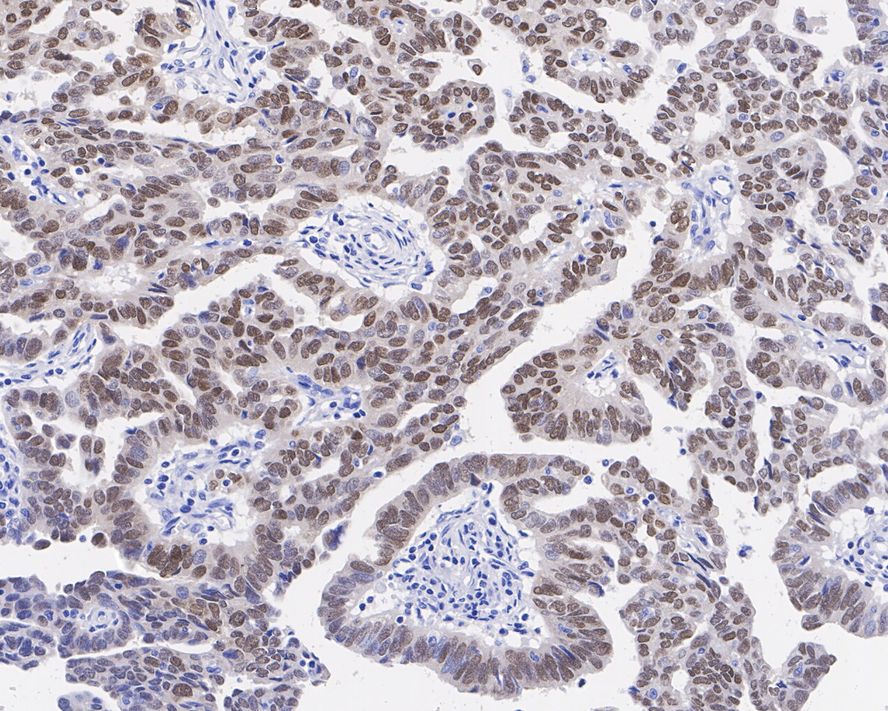 Immunohistochemical analysis of paraffin-embedded human thyroid cancer tissue using anti-PAX8 antibody. The section was pre-treated using heat mediated antigen retrieval with sodium citrate buffer (pH 6.0) for 20 minutes. The tissues were blocked in 5% BSA for 30 minutes at room temperature, washed with ddH2O and PBS, and then probed with the primary antibody (ET1701-50, 1/50)  for 30 minutes at room temperature. The detection was performed using an HRP conjugated compact polymer system. DAB was used as the chromogen. Tissues were counterstained with hematoxylin and mounted with DPX.