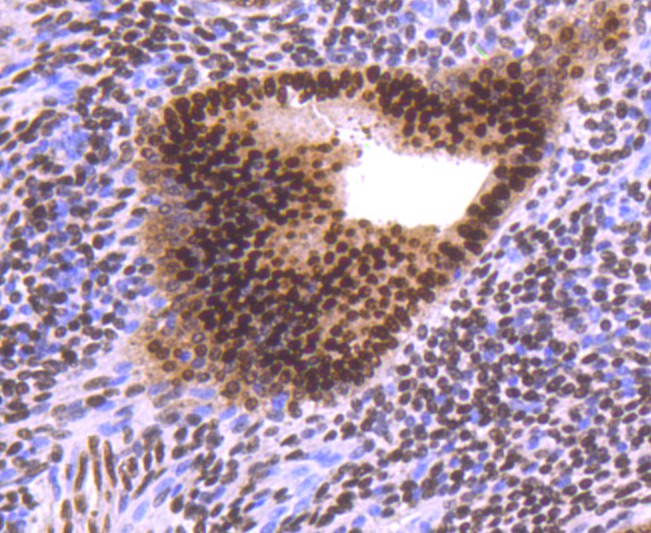 Immunohistochemical analysis of paraffin-embedded human breast tissue using anti-Progesterone Receptor antibody. The section was pre-treated using heat mediated antigen retrieval with sodium citrate buffer (pH 6.0) for 20 minutes. The tissues were blocked in 5% BSA for 30 minutes at room temperature, washed with ddH2O and PBS, and then probed with the primary antibody (ET1702-24, 1/100)  for 30 minutes at room temperature. The detection was performed using an HRP conjugated compact polymer system. DAB was used as the chromogen. Tissues were counterstained with hematoxylin and mounted with DPX.