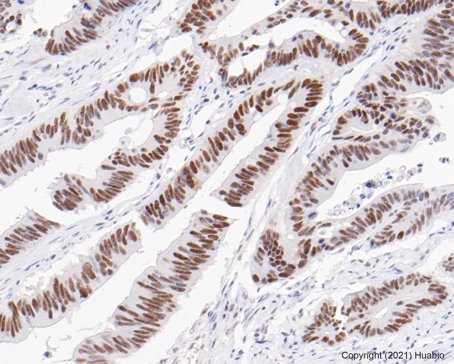 Immunohistochemical analysis of paraffin-embedded human colon carcinoma tissue using anti-PMS2 antibody. The section was pre-treated using heat mediated antigen retrieval with sodium citrate buffer (pH 6.0) for 20 minutes. The tissues were blocked in 5% BSA for 30 minutes at room temperature, washed with ddH2O and PBS, and then probed with the primary antibody (ET1605-1, 1/50)  for 30 minutes at room temperature. The detection was performed using an HRP conjugated compact polymer system. DAB was used as the chromogen. Tissues were counterstained with hematoxylin and mounted with DPX.