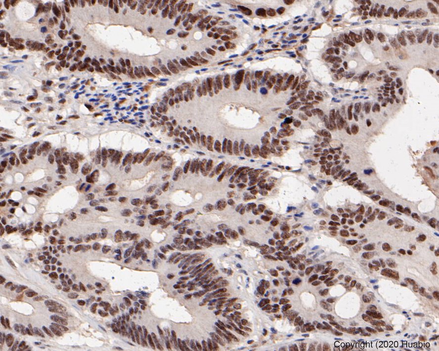 Immunohistochemical analysis of paraffin-embedded human breast carcinoma tissue using anti-PMS2 antibody. The section was pre-treated using heat mediated antigen retrieval with sodium citrate buffer (pH 6.0) for 20 minutes. The tissues were blocked in 5% BSA for 30 minutes at room temperature, washed with ddH2O and PBS, and then probed with the primary antibody (ET1605-1, 1/50)  for 30 minutes at room temperature. The detection was performed using an HRP conjugated compact polymer system. DAB was used as the chromogen. Tissues were counterstained with hematoxylin and mounted with DPX.