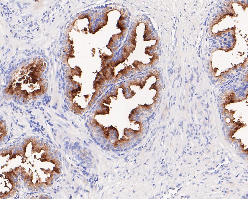 Immunohistochemical analysis of paraffin-embedded human prostate tissue using anti-PSMA antibody. The section was pre-treated using heat mediated antigen retrieval with Tris-EDTA buffer (pH 9.0) for 20 minutes.The tissues were blocked in 1% BSA for 30 minutes at room temperature, washed with ddH2O and PBS, and then probed with the primary antibody (HA600045, 1/200) for 30 minutes at room temperature. The detection was performed using an HRP conjugated compact polymer system. DAB was used as the chromogen. Tissues were counterstained with hematoxylin and mounted with DPX.