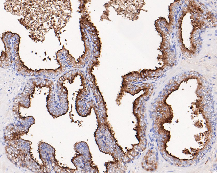 Immunohistochemical analysis of paraffin-embedded human prostate carcinoma tissue using anti-PSMA antibody. The section was pre-treated using heat mediated antigen retrieval with Tris-EDTA buffer (pH 9.0) for 20 minutes.The tissues were blocked in 1% BSA for 30 minutes at room temperature, washed with ddH2O and PBS, and then probed with the primary antibody (HA600045, 1/200) for 30 minutes at room temperature. The detection was performed using an HRP conjugated compact polymer system. DAB was used as the chromogen. Tissues were counterstained with hematoxylin and mounted with DPX.