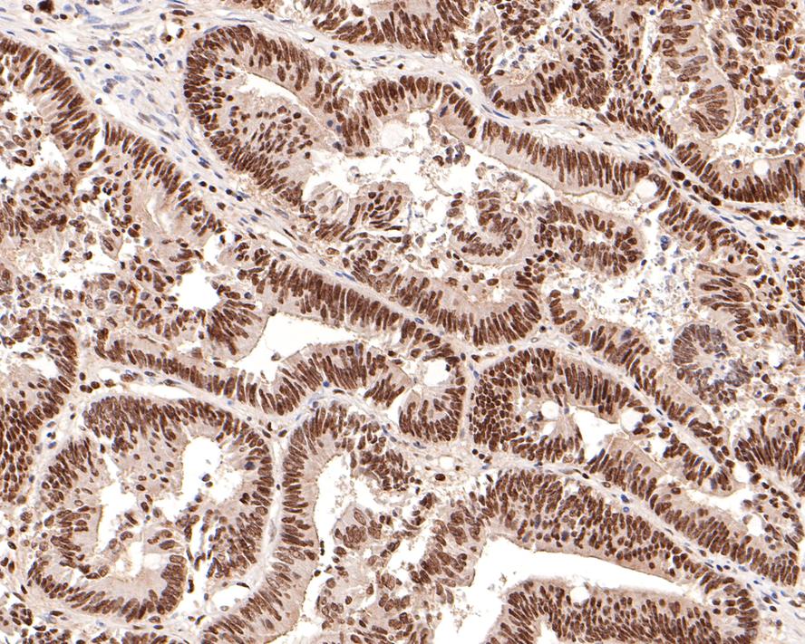 Immunohistochemical analysis of paraffin-embedded human colon carcinoma tissue with Rabbit anti-Cdc27 antibody (ET1612-94) at 1/200 dilution.<br />
<br />
The section was pre-treated using heat mediated antigen retrieval with sodium citrate buffer (pH 6.0) for 2 minutes. The tissues were blocked in 1% BSA for 20 minutes at room temperature, washed with ddH2O and PBS, and then probed with the primary antibody (ET1612-94) at 1/200 dilution for 1 hour at room temperature. The detection was performed using an HRP conjugated compact polymer system. DAB was used as the chromogen. Tissues were counterstained with hematoxylin and mounted with DPX.