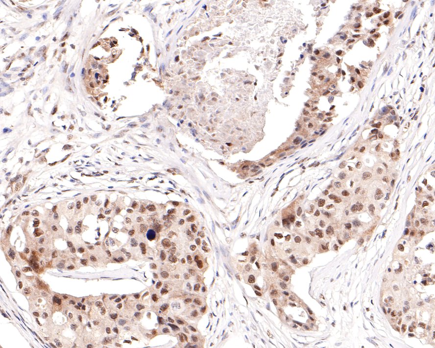 Immunohistochemical analysis of paraffin-embedded human breast carcinoma tissue with Rabbit anti-Cdc27 antibody (ET1612-94) at 1/200 dilution.<br />
<br />
The section was pre-treated using heat mediated antigen retrieval with sodium citrate buffer (pH 6.0) for 2 minutes. The tissues were blocked in 1% BSA for 20 minutes at room temperature, washed with ddH2O and PBS, and then probed with the primary antibody (ET1612-94) at 1/200 dilution for 1 hour at room temperature. The detection was performed using an HRP conjugated compact polymer system. DAB was used as the chromogen. Tissues were counterstained with hematoxylin and mounted with DPX.
