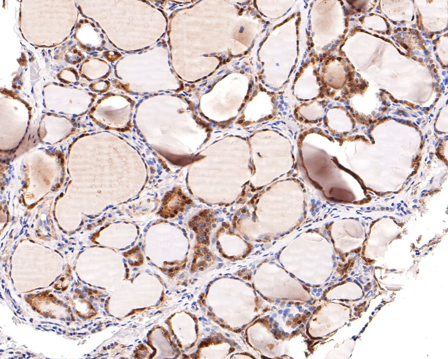 Immunohistochemical analysis of paraffin-embedded human thyroid tissue with Rabbit anti-HDAC2 antibody (ET1612-50) at 1/200 dilution.<br />
<br />
The section was pre-treated using heat mediated antigen retrieval with sodium citrate buffer (pH 6.0) for 2 minutes. The tissues were blocked in 1% BSA for 20 minutes at room temperature, washed with ddH2O and PBS, and then probed with the primary antibody (ET1612-50) at 1/200 dilution for 1 hour at room temperature. The detection was performed using an HRP conjugated compact polymer system. DAB was used as the chromogen. Tissues were counterstained with hematoxylin and mounted with DPX.