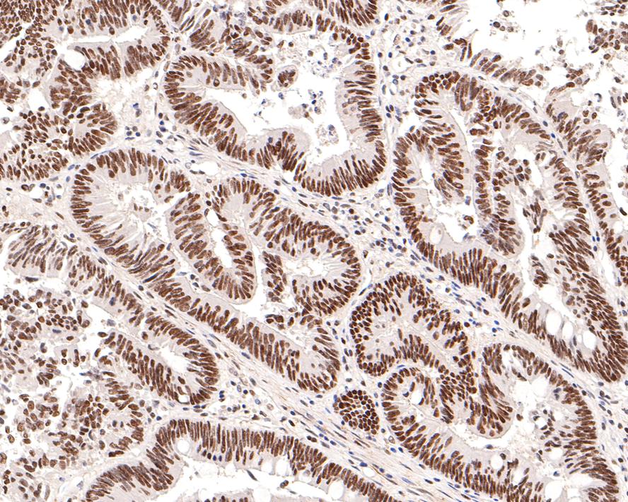 Immunohistochemical analysis of paraffin-embedded human colon carcinoma tissue with Rabbit anti-HDAC2 antibody (ET1612-50) at 1/200 dilution.<br />
<br />
The section was pre-treated using heat mediated antigen retrieval with sodium citrate buffer (pH 6.0) for 2 minutes. The tissues were blocked in 1% BSA for 20 minutes at room temperature, washed with ddH2O and PBS, and then probed with the primary antibody (ET1612-50) at 1/200 dilution for 1 hour at room temperature. The detection was performed using an HRP conjugated compact polymer system. DAB was used as the chromogen. Tissues were counterstained with hematoxylin and mounted with DPX.