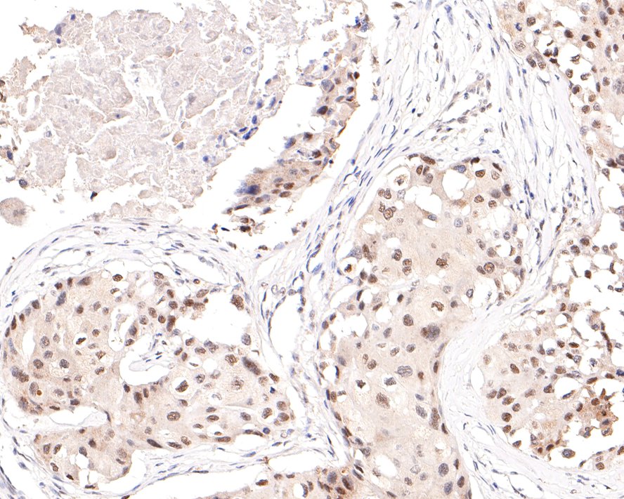 Immunohistochemical analysis of paraffin-embedded human breast carcinoma tissue with Rabbit anti-HDAC2 antibody (ET1612-50) at 1/200 dilution.<br />
<br />
The section was pre-treated using heat mediated antigen retrieval with sodium citrate buffer (pH 6.0) for 2 minutes. The tissues were blocked in 1% BSA for 20 minutes at room temperature, washed with ddH2O and PBS, and then probed with the primary antibody (ET1612-50) at 1/200 dilution for 1 hour at room temperature. The detection was performed using an HRP conjugated compact polymer system. DAB was used as the chromogen. Tissues were counterstained with hematoxylin and mounted with DPX.