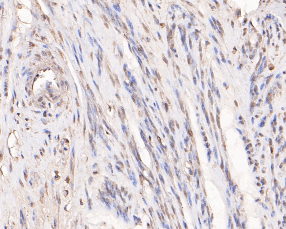 Immunohistochemical analysis of paraffin-embedded human cervix tissue using anti-RBBP7 antibody. The section was pre-treated using heat mediated antigen retrieval with sodium citrate buffer (pH 6.0) for 20 minutes. The tissues were blocked in 5% BSA for 30 minutes at room temperature, washed with ddH2O and PBS, and then probed with the primary antibody (HA500155, 1/400)  for 30 minutes at room temperature. The detection was performed using an HRP conjugated compact polymer system. DAB was used as the chromogen. Tissues were counterstained with hematoxylin and mounted with DPX.