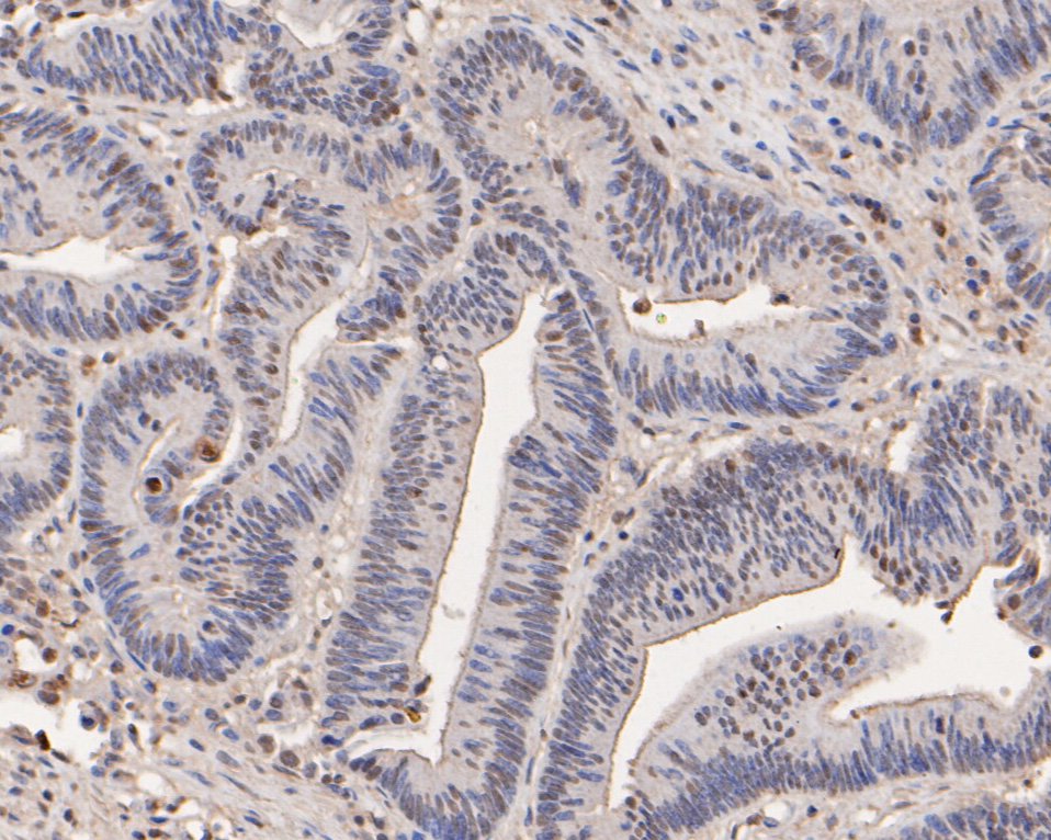 Immunohistochemical analysis of paraffin-embedded human colon carcinoma tissue using anti-RBBP7 antibody. The section was pre-treated using heat mediated antigen retrieval with sodium citrate buffer (pH 6.0) for 20 minutes. The tissues were blocked in 5% BSA for 30 minutes at room temperature, washed with ddH2O and PBS, and then probed with the primary antibody (HA500155, 1/400)  for 30 minutes at room temperature. The detection was performed using an HRP conjugated compact polymer system. DAB was used as the chromogen. Tissues were counterstained with hematoxylin and mounted with DPX.
