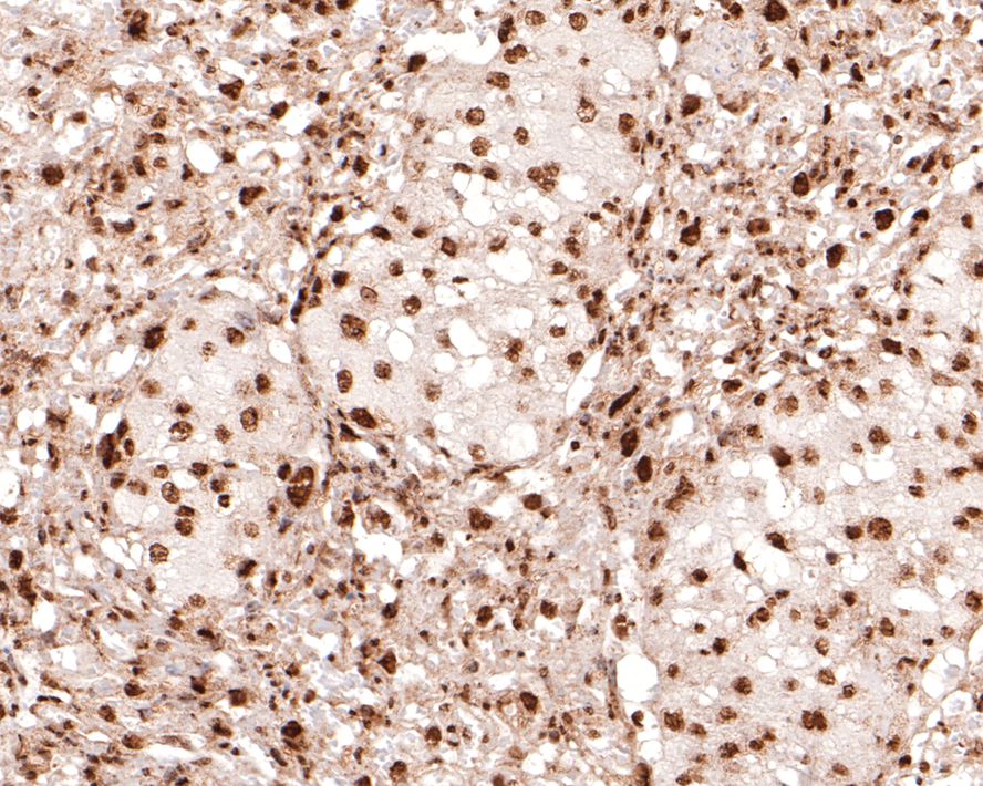 Immunohistochemical analysis of paraffin-embedded mouse placenta tissue with Rabbit anti-Lin28 antibody (ET1704-26) at 1/400 dilution.<br />
<br />
The section was pre-treated using heat mediated antigen retrieval with sodium citrate buffer (pH 6.0) for 2 minutes. The tissues were blocked in 1% BSA for 20 minutes at room temperature, washed with ddH2O and PBS, and then probed with the primary antibody (ET1704-26) at 1/400 dilution for 1 hour at room temperature. The detection was performed using an HRP conjugated compact polymer system. DAB was used as the chromogen. Tissues were counterstained with hematoxylin and mounted with DPX.