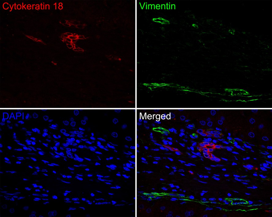 Immunofluorescence analysis of paraffin-embedded human liver tissue labeling Cytokeratin 18 (HA720151F) and Vimentin (EM0401).<br />
<br />
The section was pre-treated using heat mediated antigen retrieval with Tris-EDTA buffer (pH 9.0) for 20 minutes. The tissues were blocked in 10% negative goat serum for 1 hour at room temperature, washed with PBS. And then probed with the primary antibodies Cytokeratin 18 (HA720151F, red) at 1/50 dilution and Vimentin (EM0401, green) at 1/1,000 dilution overnight at 4 ℃, washed with PBS.<br />
<br />
iFluor™ 488 conjugate-Goat anti-Mouse IgG (HA1125) was used as the secondary antibody at 1/1,000 dilution. DAPI was used as nuclear counterstain.