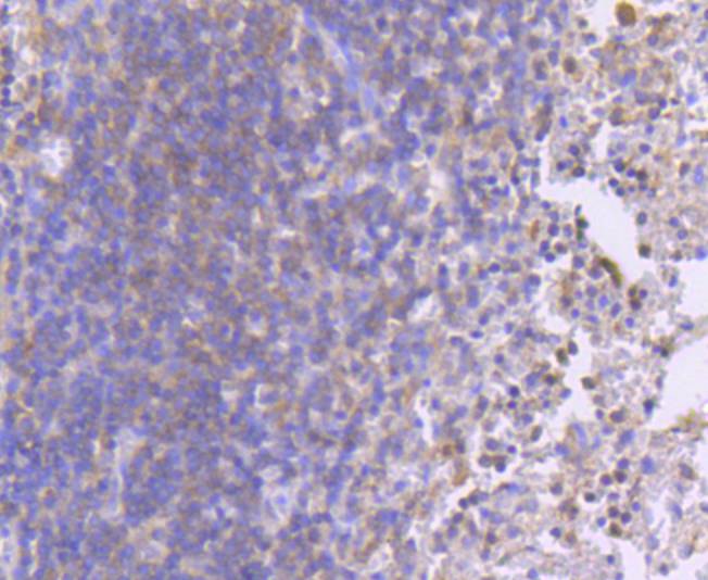 Immunohistochemical analysis of paraffin-embedded human breast carcinoma tissue using anti-Phospho-MEK1(S218/S222) antibody. The section was pre-treated using heat mediated antigen retrieval with Tris-EDTA buffer (pH 8.0-8.4) for 20 minutes.The tissues were blocked in 5% BSA for 30 minutes at room temperature, washed with ddH2O and PBS, and then probed with the primary antibody (ET1609-50, 1/50) for 30 minutes at room temperature. The detection was performed using an HRP conjugated compact polymer system. DAB was used as the chromogen. Tissues were counterstained with hematoxylin and mounted with DPX.