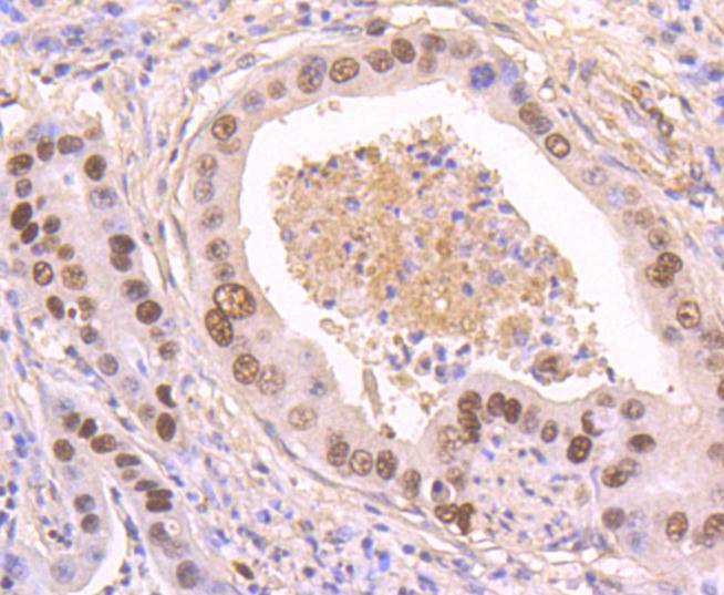 Immunohistochemical analysis of paraffin-embedded human stomach carcinoma tissue using anti-Phospho-p53 (S392) antibody. The section was pre-treated using heat mediated antigen retrieval with Tris-EDTA buffer (pH 8.0-8.4) for 20 minutes.The tissues were blocked in 5% BSA for 30 minutes at room temperature, washed with ddH2O and PBS, and then probed with the primary antibody (ET1606-24, 1/50) for 30 minutes at room temperature. The detection was performed using an HRP conjugated compact polymer system. DAB was used as the chromogen. Tissues were counterstained with hematoxylin and mounted with DPX.