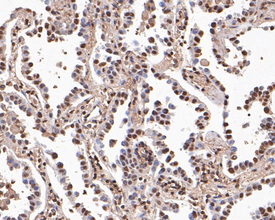 Immunohistochemical analysis of paraffin-embedded human lung carcinoma tissue using anti-BRG1 antibody. The section was pre-treated using heat mediated antigen retrieval with sodium citrate buffer (pH 6.0) for 20 minutes. The tissues were blocked in 5% BSA for 30 minutes at room temperature, washed with ddH2O and PBS, and then probed with the primary antibody (HA500262, 1/400)  for 30 minutes at room temperature. The detection was performed using an HRP conjugated compact polymer system. DAB was used as the chromogen. Tissues were counterstained with hematoxylin and mounted with DPX.
