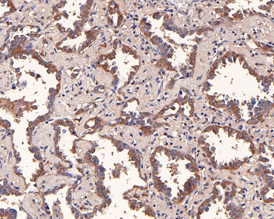 Immunohistochemical analysis of paraffin-embedded human lung carcinoma tissue with Rabbit anti-CTPS antibody (HA721003) at 1/50 dilution.<br />
<br />
The section was pre-treated using heat mediated antigen retrieval with Tris-EDTA buffer (pH 9.0) for 20 minutes. The tissues were blocked in 1% BSA for 20 minutes at room temperature, washed with ddH2O and PBS, and then probed with the primary antibody (HA721003) at 1/50 dilution for 1 hour at room temperature. The detection was performed using an HRP conjugated compact polymer system. DAB was used as the chromogen. Tissues were counterstained with hematoxylin and mounted with DPX.