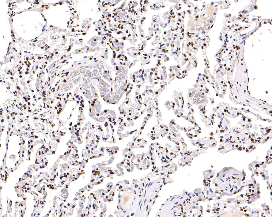 Immunohistochemical analysis of paraffin-embedded human lung tissue with Mouse anti-Histone H3 (acetyl K18) antibody (HA600090) at 1/500 dilution.<br />
<br />
The section was pre-treated using heat mediated antigen retrieval with sodium citrate buffer (pH 6.0) for 2 minutes. The tissues were blocked in 1% BSA for 20 minutes at room temperature, washed with ddH2O and PBS, and then probed with the primary antibody (HA600090) at 1/500 dilution for 1 hour at room temperature. The detection was performed using an HRP conjugated compact polymer system. DAB was used as the chromogen. Tissues were counterstained with hematoxylin and mounted with DPX.