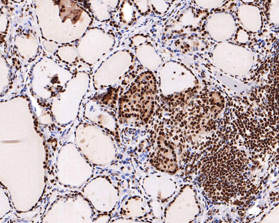 Immunohistochemical analysis of paraffin-embedded human thyroid tissue with Mouse anti-Histone H3 (acetyl K18) antibody (HA600090) at 1/500 dilution.<br />
<br />
The section was pre-treated using heat mediated antigen retrieval with sodium citrate buffer (pH 6.0) for 2 minutes. The tissues were blocked in 1% BSA for 20 minutes at room temperature, washed with ddH2O and PBS, and then probed with the primary antibody (HA600090) at 1/500 dilution for 1 hour at room temperature. The detection was performed using an HRP conjugated compact polymer system. DAB was used as the chromogen. Tissues were counterstained with hematoxylin and mounted with DPX.