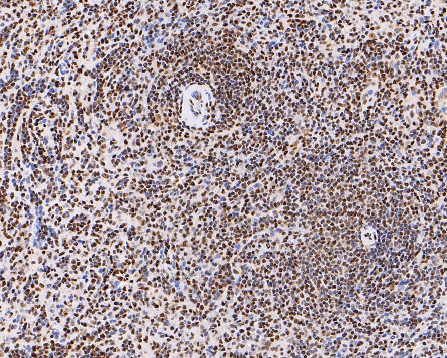 Immunohistochemical analysis of paraffin-embedded human spleen tissue with Mouse anti-Histone H3 (acetyl K18) antibody (HA600090) at 1/500 dilution.<br />
<br />
The section was pre-treated using heat mediated antigen retrieval with sodium citrate buffer (pH 6.0) for 2 minutes. The tissues were blocked in 1% BSA for 20 minutes at room temperature, washed with ddH2O and PBS, and then probed with the primary antibody (HA600090) at 1/500 dilution for 1 hour at room temperature. The detection was performed using an HRP conjugated compact polymer system. DAB was used as the chromogen. Tissues were counterstained with hematoxylin and mounted with DPX.