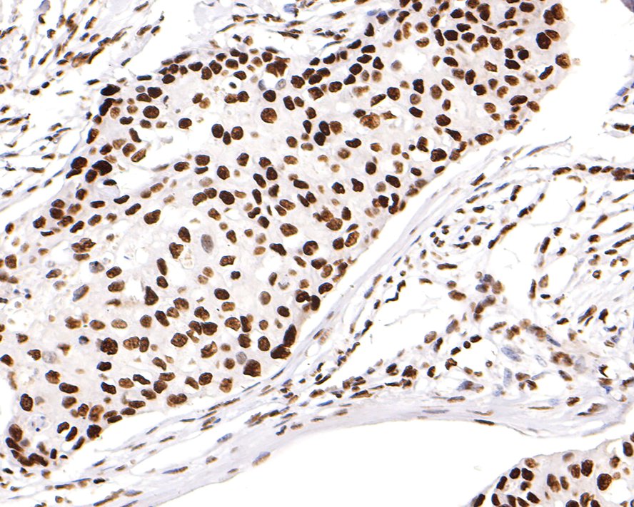 Immunohistochemical analysis of paraffin-embedded human breast carcinoma tissue with Mouse anti-Histone H3 (acetyl K18) antibody (HA600090) at 1/500 dilution.<br />
<br />
The section was pre-treated using heat mediated antigen retrieval with sodium citrate buffer (pH 6.0) for 2 minutes. The tissues were blocked in 1% BSA for 20 minutes at room temperature, washed with ddH2O and PBS, and then probed with the primary antibody (HA600090) at 1/500 dilution for 1 hour at room temperature. The detection was performed using an HRP conjugated compact polymer system. DAB was used as the chromogen. Tissues were counterstained with hematoxylin and mounted with DPX.