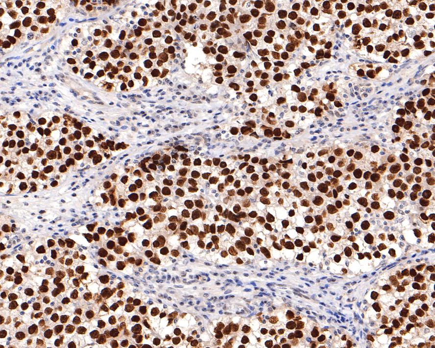 Immunohistochemical analysis of paraffin-embedded human seminoma tissue with Mouse anti-Sall4 antibody (HA600089) at 1/600 dilution.<br />
<br />
The section was pre-treated using heat mediated antigen retrieval with sodium citrate buffer (pH 6.0) for 2 minutes. The tissues were blocked in 1% BSA for 20 minutes at room temperature, washed with ddH2O and PBS, and then probed with the primary antibody (HA600089) at 1/600 dilution for 1 hour at room temperature. The detection was performed using an HRP conjugated compact polymer system. DAB was used as the chromogen. Tissues were counterstained with hematoxylin and mounted with DPX.