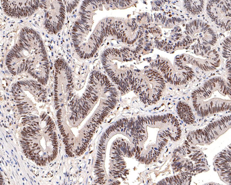Immunohistochemical analysis of paraffin-embedded human colon carcinoma tissue with Rabbit anti-DNA PKcs antibody (ET1610-12) at 1/200 dilution.<br />
<br />
The section was pre-treated using heat mediated antigen retrieval with sodium citrate buffer (pH 6.0) for 2 minutes. The tissues were blocked in 1% BSA for 20 minutes at room temperature, washed with ddH2O and PBS, and then probed with the primary antibody (ET1610-12) at 1/200 dilution for 1 hour at room temperature. The detection was performed using an HRP conjugated compact polymer system. DAB was used as the chromogen. Tissues were counterstained with hematoxylin and mounted with DPX.