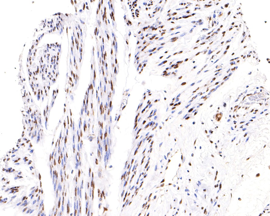 Immunohistochemical analysis of paraffin-embedded human cervix tissue with Rabbit anti-Phospho-ATF2(T71) antibody (ET1610-30) at 1/200 dilution.<br />
<br />
The section was pre-treated using heat mediated antigen retrieval with sodium citrate buffer (pH 6.0) for 2 minutes. The tissues were blocked in 1% BSA for 20 minutes at room temperature, washed with ddH2O and PBS, and then probed with the primary antibody (ET1610-30) at 1/200 dilution for 1 hour at room temperature. The detection was performed using an HRP conjugated compact polymer system. DAB was used as the chromogen. Tissues were counterstained with hematoxylin and mounted with DPX.