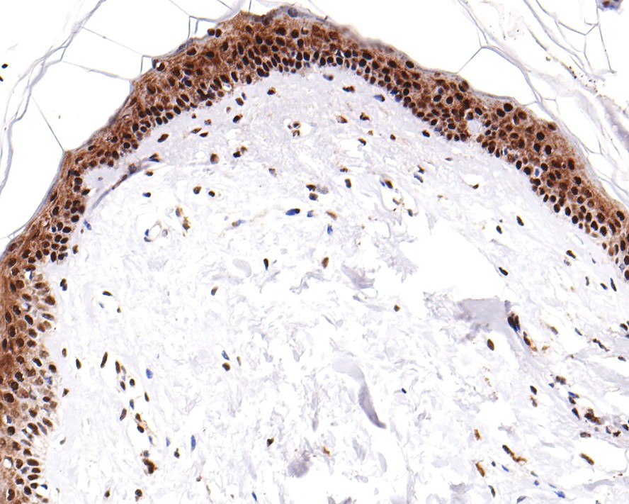 Immunohistochemical analysis of paraffin-embedded human skin tissue with Rabbit anti-Phospho-ATF2(T71) antibody (ET1610-30) at 1/200 dilution.<br />
<br />
The section was pre-treated using heat mediated antigen retrieval with sodium citrate buffer (pH 6.0) for 2 minutes. The tissues were blocked in 1% BSA for 20 minutes at room temperature, washed with ddH2O and PBS, and then probed with the primary antibody (ET1610-30) at 1/200 dilution for 1 hour at room temperature. The detection was performed using an HRP conjugated compact polymer system. DAB was used as the chromogen. Tissues were counterstained with hematoxylin and mounted with DPX.