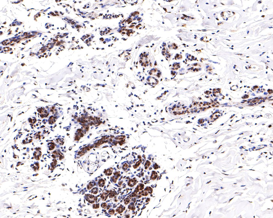 Immunohistochemical analysis of paraffin-embedded human breast tissue with Rabbit anti-Phospho-ATF2(T71) antibody (ET1610-30) at 1/200 dilution.<br />
<br />
The section was pre-treated using heat mediated antigen retrieval with sodium citrate buffer (pH 6.0) for 2 minutes. The tissues were blocked in 1% BSA for 20 minutes at room temperature, washed with ddH2O and PBS, and then probed with the primary antibody (ET1610-30) at 1/200 dilution for 1 hour at room temperature. The detection was performed using an HRP conjugated compact polymer system. DAB was used as the chromogen. Tissues were counterstained with hematoxylin and mounted with DPX.