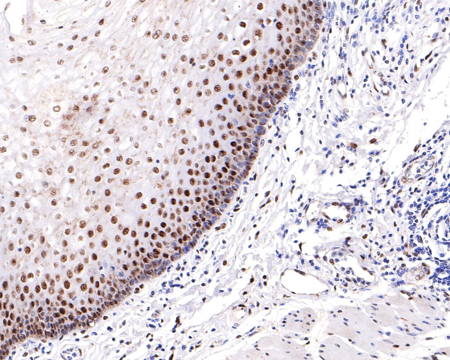 Immunohistochemical analysis of paraffin-embedded human esophagus tissue with Rabbit anti-Phospho-ATF2(T71) antibody (ET1610-30) at 1/200 dilution.<br />
<br />
The section was pre-treated using heat mediated antigen retrieval with sodium citrate buffer (pH 6.0) for 2 minutes. The tissues were blocked in 1% BSA for 20 minutes at room temperature, washed with ddH2O and PBS, and then probed with the primary antibody (ET1610-30) at 1/200 dilution for 1 hour at room temperature. The detection was performed using an HRP conjugated compact polymer system. DAB was used as the chromogen. Tissues were counterstained with hematoxylin and mounted with DPX.