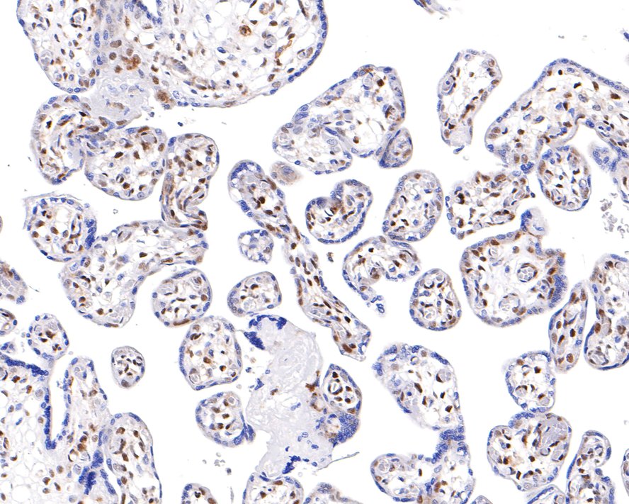 Immunohistochemical analysis of paraffin-embedded human placenta tissue with Rabbit anti-Phospho-ATF2(T71) antibody (ET1610-30) at 1/200 dilution.<br />
<br />
The section was pre-treated using heat mediated antigen retrieval with sodium citrate buffer (pH 6.0) for 2 minutes. The tissues were blocked in 1% BSA for 20 minutes at room temperature, washed with ddH2O and PBS, and then probed with the primary antibody (ET1610-30) at 1/200 dilution for 1 hour at room temperature. The detection was performed using an HRP conjugated compact polymer system. DAB was used as the chromogen. Tissues were counterstained with hematoxylin and mounted with DPX.