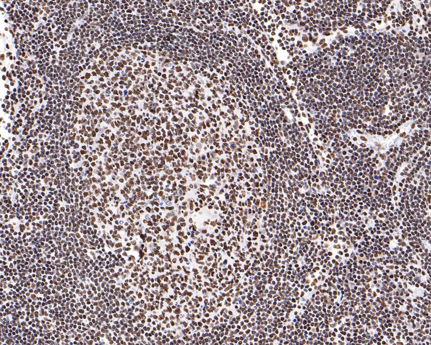 Immunohistochemical analysis of paraffin-embedded human lymph nodes tissue with Rabbit anti-PTBP1 antibody (ET7106-58) at 1/400 dilution.<br />
<br />
The section was pre-treated using heat mediated antigen retrieval with sodium citrate buffer (pH 6.0) for 2 minutes. The tissues were blocked in 1% BSA for 20 minutes at room temperature, washed with ddH2O and PBS, and then probed with the primary antibody (ET7106-58) at 1/400 dilution for 1 hour at room temperature. The detection was performed using an HRP conjugated compact polymer system. DAB was used as the chromogen. Tissues were counterstained with hematoxylin and mounted with DPX.