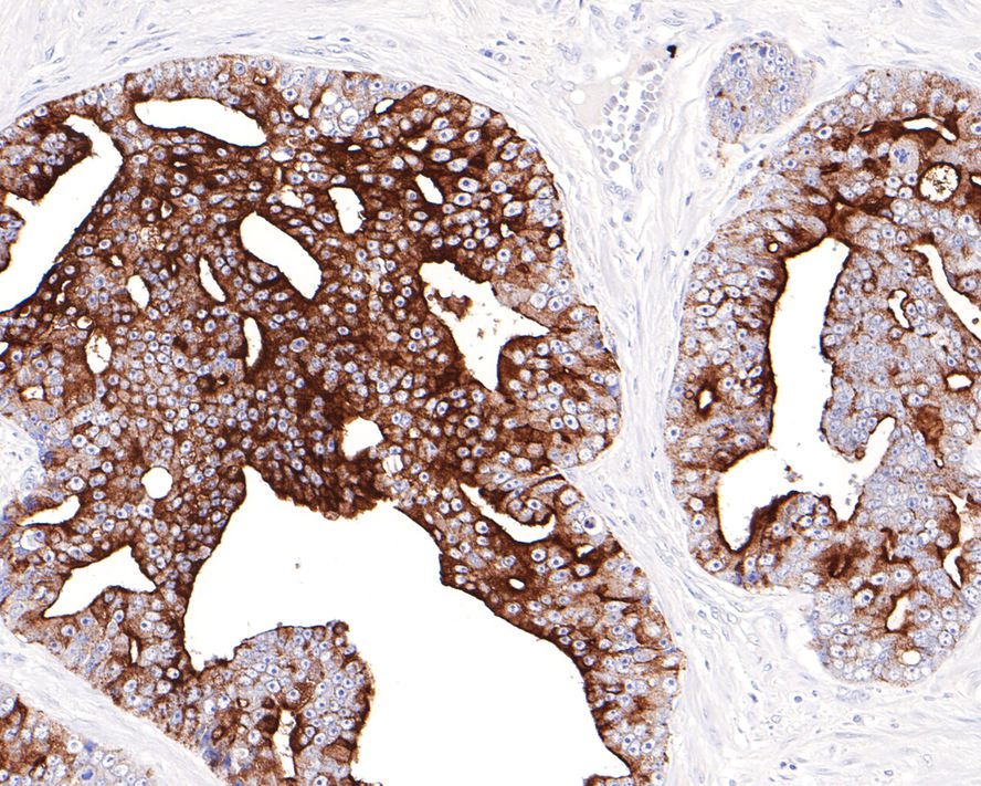 Immunohistochemical analysis of paraffin-embedded human prostate carcinoma tissue with Rabbit anti-Prostate Specific Antigen antibody (ET1612-19) at 1/1,000 dilution.<br />
<br />
The section was pre-treated using heat mediated antigen retrieval with Tris-EDTA buffer (pH 9.0) for 20 minutes. The tissues were blocked in 1% BSA for 20 minutes at room temperature, washed with ddH2O and PBS, and then probed with the primary antibody (ET1612-19) at 1/1,000 dilution for 1 hour at room temperature. The detection was performed using an HRP conjugated compact polymer system. DAB was used as the chromogen. Tissues were counterstained with hematoxylin and mounted with DPX.