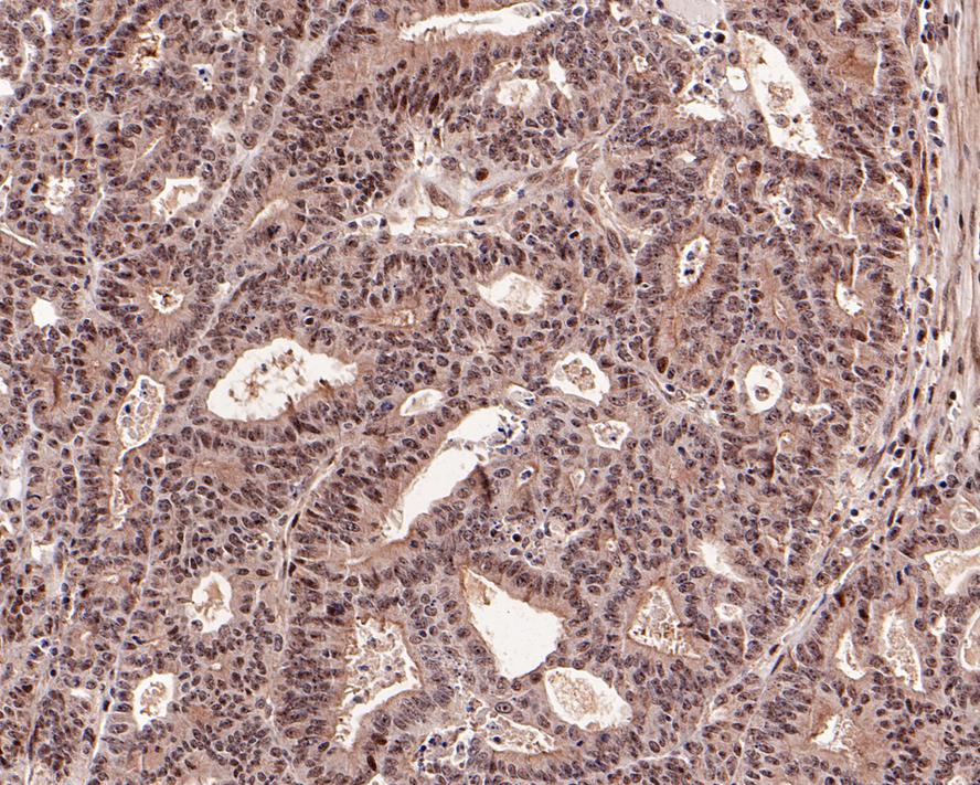Immunohistochemical analysis of paraffin-embedded human colon carcinoma tissue with Rabbit anti-Phospho-AKT1 (T450) antibody (ET1612-73) at 1/50 dilution.<br />
<br />
The section was pre-treated using heat mediated antigen retrieval with Tris-EDTA buffer (pH 9.0) for 20 minutes. The tissues were blocked in 1% BSA for 20 minutes at room temperature, washed with ddH2O and PBS, and then probed with the primary antibody (ET1612-73) at 1/50 dilution for 1 hour at room temperature. The detection was performed using an HRP conjugated compact polymer system. DAB was used as the chromogen. Tissues were counterstained with hematoxylin and mounted with DPX.