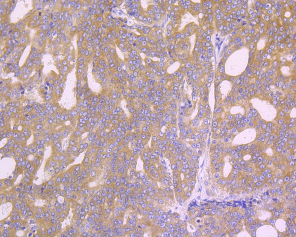 Immunohistochemical analysis of paraffin-embedded human prostate carcinoma tissue using anti-Phospho-EIF2S1 (S51) antibody. The section was pre-treated using heat mediated antigen retrieval with Tris-EDTA buffer (pH 8.0-8.4) for 20 minutes.The tissues were blocked in 5% BSA for 30 minutes at room temperature, washed with ddH2O and PBS, and then probed with the primary antibody (ET1603-14, 1/50) for 30 minutes at room temperature. The detection was performed using an HRP conjugated compact polymer system. DAB was used as the chromogen. Tissues were counterstained with hematoxylin and mounted with DPX.