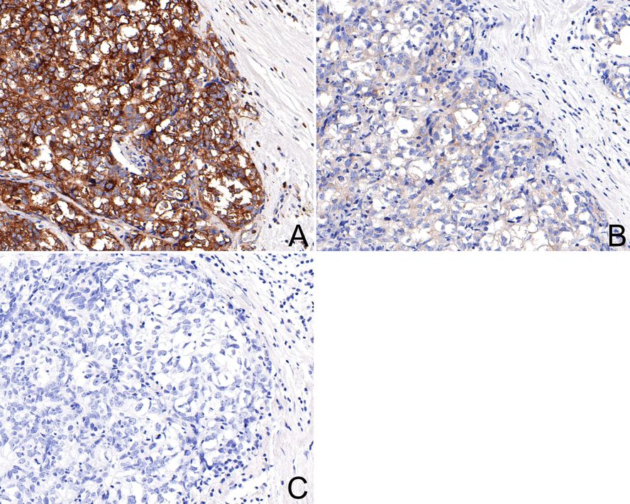 Immunohistochemical analysis of paraffin-embedded human breast carcinoma tissue with Rabbit anti-Phospho-EIF2S1 (S51) antibody (ET1603-14) at 1/200 dilution. <br />
<br />
A: Untreated human breast carcinoma tissue<br />
B: λ-PPase treated human breast carcinoma tissue<br />
C: Negative control<br />
<br />
The section was pre-treated using heat mediated antigen retrieval with Tris-EDTA buffer (pH 9.0) for 20 minutes. The tissues were blocked in 1% BSA for 20 minutes at room temperature, washed with ddH2O and PBS, and then probed with the primary antibody (ET1603-14) at 1/200 dilution for 1 hour at room temperature. The detection was performed using an HRP conjugated compact polymer system. DAB was used as the chromogen. Tissues were counterstained with hematoxylin and mounted with DPX.