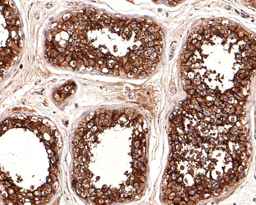 Immunohistochemical analysis of paraffin-embedded human testis tissue with Rabbit anti-ChT1 antibody (HA500314) at 1/600 dilution.<br />
<br />
The section was pre-treated using heat mediated antigen retrieval with Tris-EDTA buffer (pH 9.0) for 20 minutes. The tissues were blocked in 1% BSA for 20 minutes at room temperature, washed with ddH2O and PBS, and then probed with the primary antibody (HA500314) at 1/600 dilution for 1 hour at room temperature. The detection was performed using an HRP conjugated compact polymer system. DAB was used as the chromogen. Tissues were counterstained with hematoxylin and mounted with DPX.