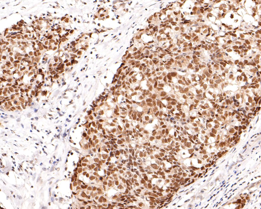 Immunohistochemical analysis of paraffin-embedded human colon tissue with Mouse anti-Nuclear Receptor Corepressor antibody (HA600055) at 1/600 dilution.<br />
<br />
The section was pre-treated using heat mediated antigen retrieval with sodium citrate buffer (pH 6.0) for 2 minutes. The tissues were blocked in 1% BSA for 20 minutes at room temperature, washed with ddH2O and PBS, and then probed with the primary antibody (HA600055) at 1/600 dilution for 1 hour at room temperature. The detection was performed using an HRP conjugated compact polymer system. DAB was used as the chromogen. Tissues were counterstained with hematoxylin and mounted with DPX.