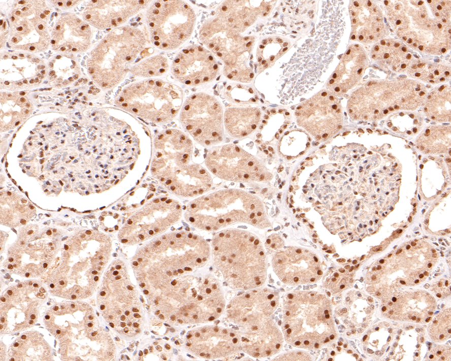 Immunohistochemical analysis of paraffin-embedded human breast carcinoma tissue with Mouse anti-Nuclear Receptor Corepressor antibody (HA600055) at 1/600 dilution.<br />
<br />
The section was pre-treated using heat mediated antigen retrieval with sodium citrate buffer (pH 6.0) for 2 minutes. The tissues were blocked in 1% BSA for 20 minutes at room temperature, washed with ddH2O and PBS, and then probed with the primary antibody (HA600055) at 1/600 dilution for 1 hour at room temperature. The detection was performed using an HRP conjugated compact polymer system. DAB was used as the chromogen. Tissues were counterstained with hematoxylin and mounted with DPX.